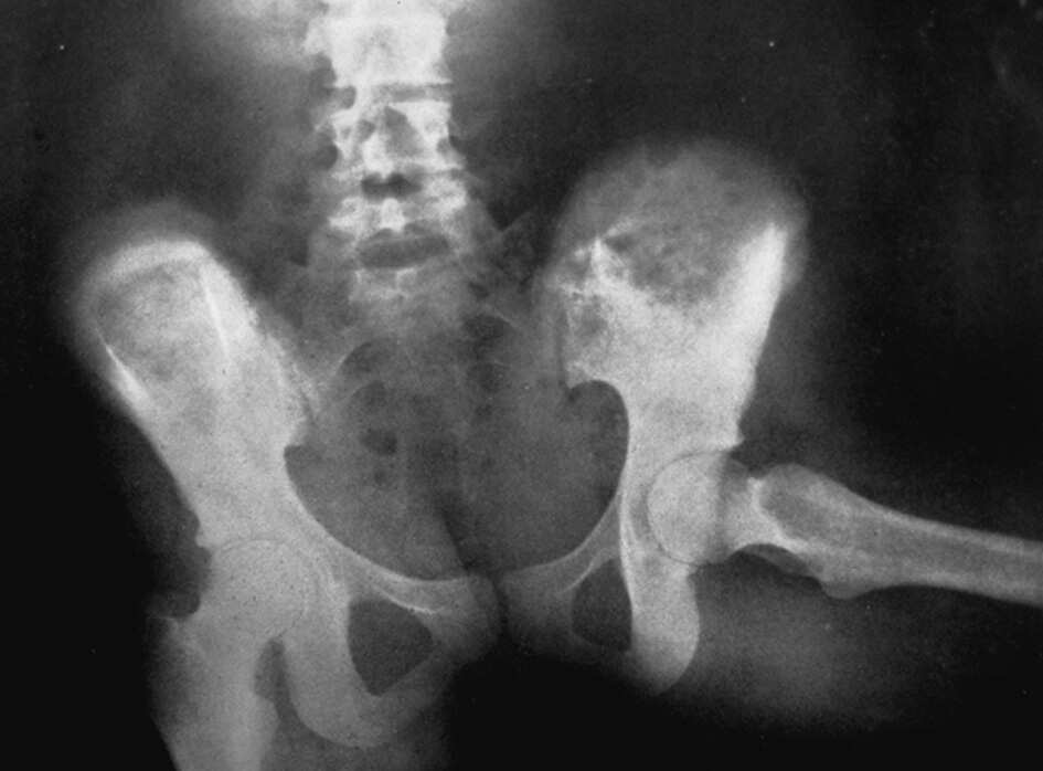X-ray of a spine and pelvic region showing bone structure